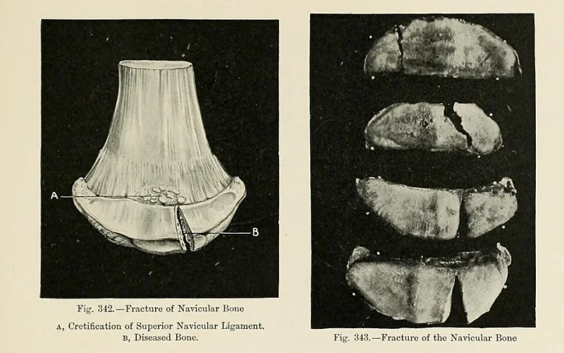 Síndrome navicular — 🩺 Cuidados y salud